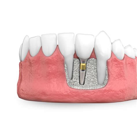Dental Implants Loveland, CO - Implant Dentistry - West Lake Dental