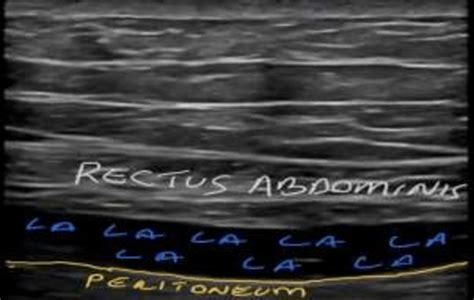 Ultrasound Guided Rectus Sheath Block And Local Anaesthetics