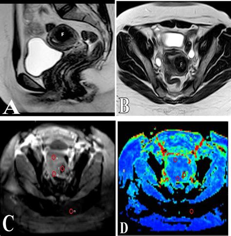 Fertile Female Patient Aged 44 Years Old A B Sagittal And Axial T2wi