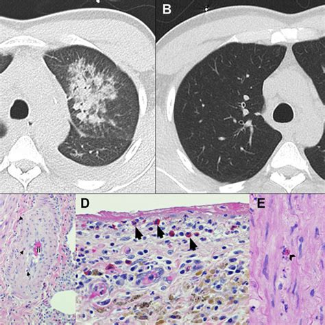 Pdf Eosinophilic Granulomatosis With Polyangiitis Presenting As An