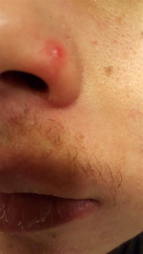 Acne Blind Pimple On Nose Please Help Skincareaddiction