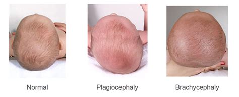 What Is Flat Head Syndrome Cherish Baby Care