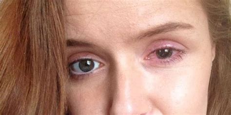 This Woman Spent 5 Days In The Dark After A Contact Lens Tore Her Eye