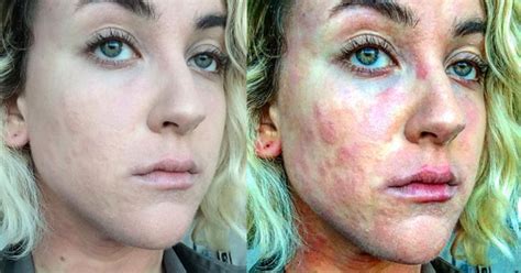 Woman With Psoriasis Shows What Its Really Like Living With The Skin