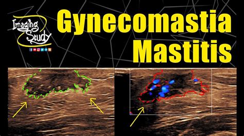 Gynecomastia With Mastitis Ultrasound Doppler Case 279 Youtube