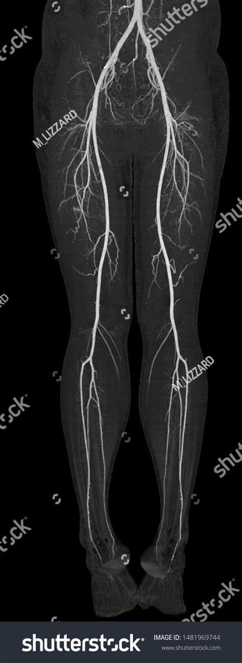 Ct Scan Vascular Both Leg Anterior 스톡 일러스트 1481969744 Shutterstock