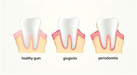 The Importance Of Gum Health 3v Dental Associates Port Washington Ny