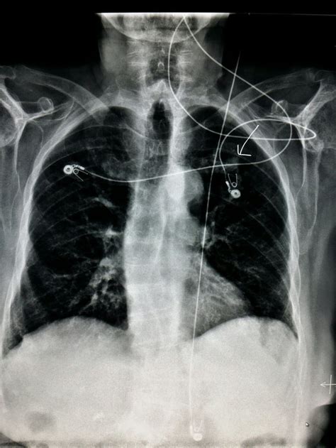 Lung Cancer On Chest X Ray