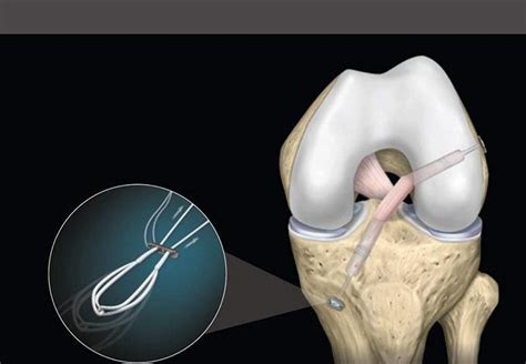 Basics Of Knee Arthroscopy And Acl Reconstruction Course مجلة نبض