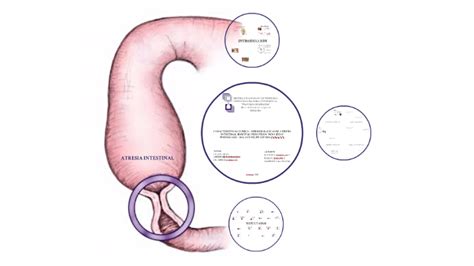 Atresia Intestinal By Isabel Hernandez