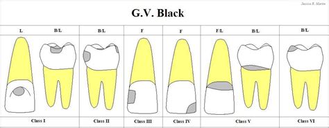 They are microbial diseases leading to calcification of the tissues of the teeth. G.V. Black's Classification of Carious Lesions / Caries ...