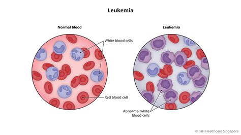 Leukemia Blood Cancer Symptoms And Causes Mount Elizabeth Hospitals
