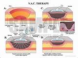 Images of Vac Therapy