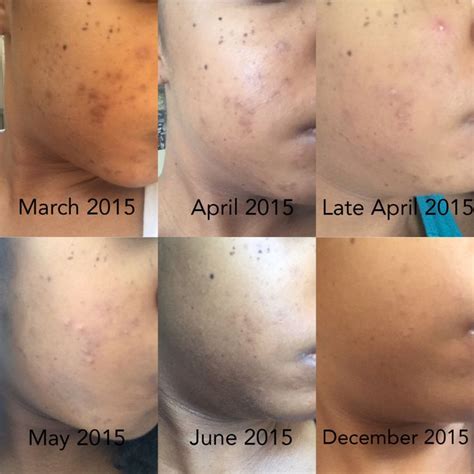 I Cleared Up My Hyperpigmentation With This 5 Step Method Lighten
