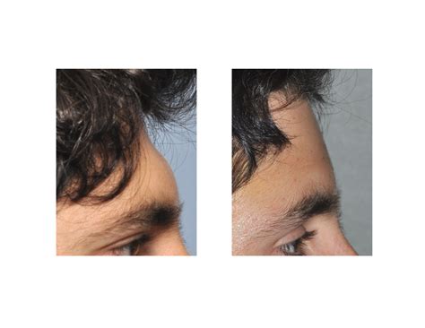 Plastic Surgery Case Study Male Forehead Augmentation Explore