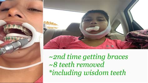 8 Teeth Removed Including Wisdom Teeth Getting Braces Youtube