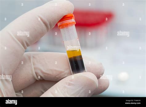 Scientist Holding In His Hand A Centrifuged Blood Sample With Hemolysis
