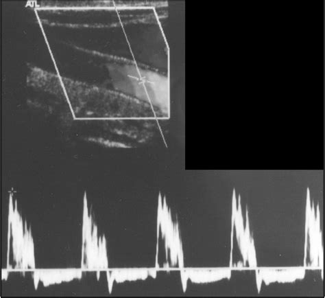 Figure From A Spectrum Of Doppler Waveforms In The Carotid And