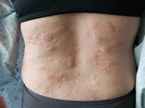 Hives Urticaria — The Tic Tac Toe That We Can Create On Our Skin Dr Ben Medical Mens