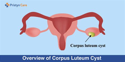 Overview Of Corpus Luteum Cyst Pristyn Care
