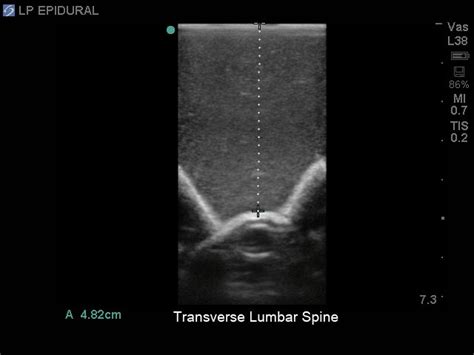 Blue Phantom Spinal Epidural Lumbar Puncture And Cervical Epidural