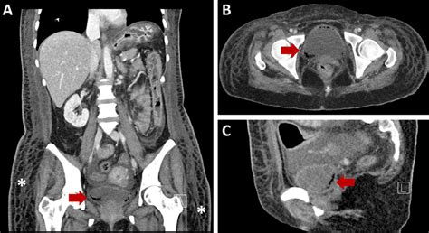Non Contrast Enhanced Ct Scan Of The Abdomen And Pelvis Showing Diffuse