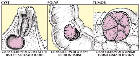 Cyst Polyp And Tumor Students Britannica Kids Homework Help
