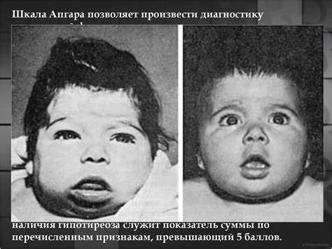 Врожденный гипотиреоз - презентация онлайн Картинка - Врожденный гипотиреоз - презентация онлайн