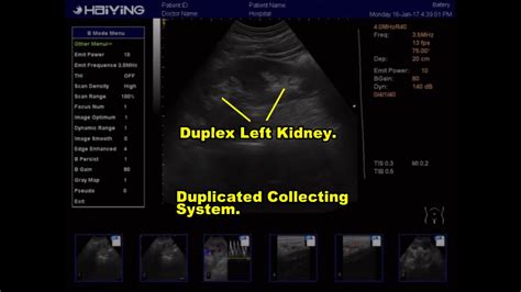 Renal Ultrasoundduplex Kidneystone At Ureterovesical Junction Youtube