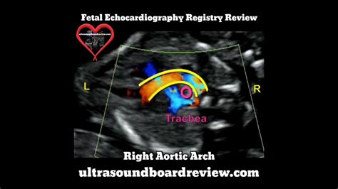 Right Aortic Arch Fetal Echocardiography Youtube