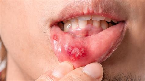 10 Home Remedies For Canker Sores 10 Home Remedies