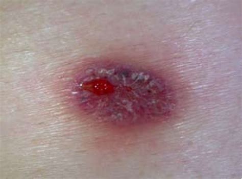 Figure 1 From A Case Of Superficial Granulomatous Pyoderma Mimicking A