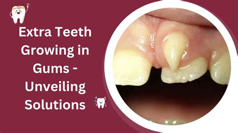 Extra Teeth Growing In Gums Unveiling Solutions