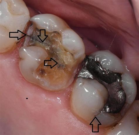 Worn Cracked Or Broken Teeth Bega Dental Practice