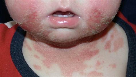 Milenium Home Tips Baby Rash On Face And Chest After Fever