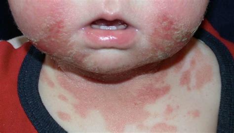 An ointment or even diaper rash cream can form a helpful barrier on your child's neck if drool is the principal cause of the rash. Drool rash: Treatment, prevention, and when to see a doctor