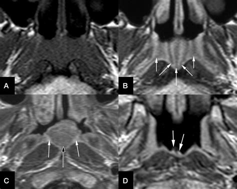 Nasopharyngeal Mucosa And Adenoids Appearance At Mr Imaging Radiology