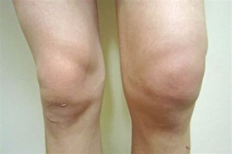 Knee Bursitis Knee Bursitis Treatment No Fault Doctor In Forest Hills