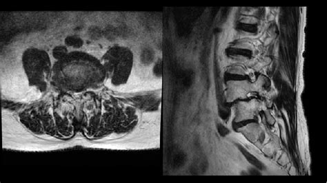Mri Showing Grade Ii Listhesis With L4 L5 Right Foraminal Stenosis