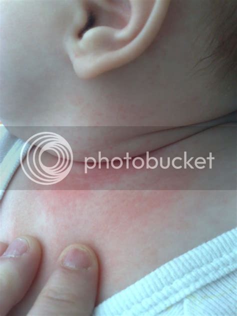 Neck Rash Sorry This Is Long Babycenter