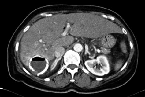 Contrast Enhanced Abdominal Ct Section In The Right Hepatic Lobe Lhc