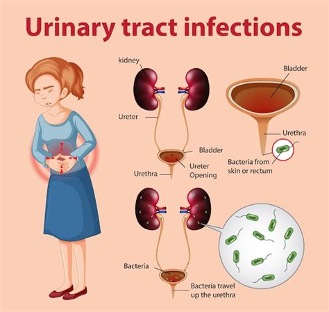 Ilustraci N Informativa De Infecciones Del Tracto Urinario Vector Premium