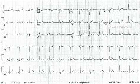 12 Lead Ecg Depicting Reversal Of V1 And V6 A Ecg Recording B All In