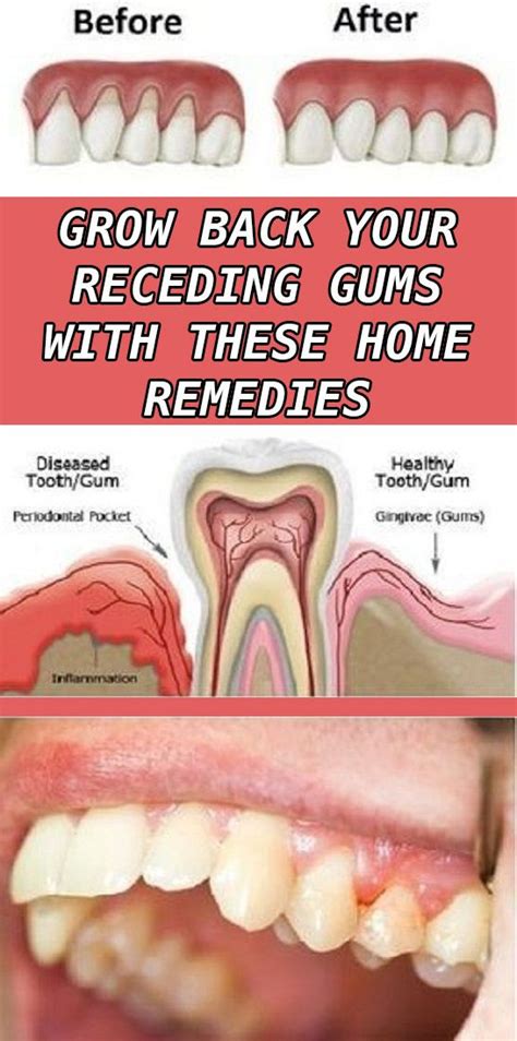 8 Easy Ways To Heal Receding Gums Naturally Gum Disease Treatment