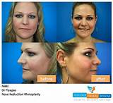 Payment Plans For Rhinoplasty Images