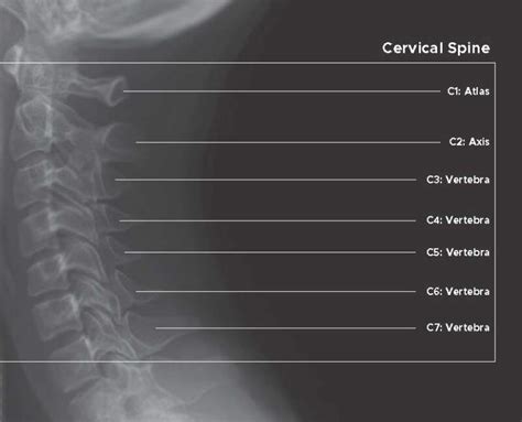 Figure X Ray Image Of Cervical Spine Contributed By Chelsea Rowe