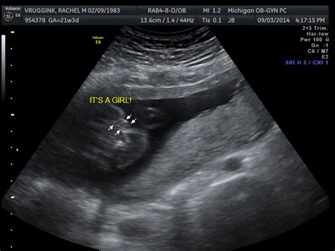 Baby V 4 20 Week Ultrasound The Vrugginks In Asia