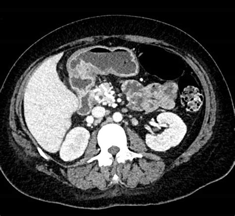 Gastric Antral Calcification Stomach Case Studies Ctisus Ct Scanning