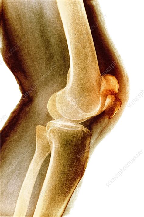 Fractured Kneecap X Ray Stock Image M3301567 Science Photo Library