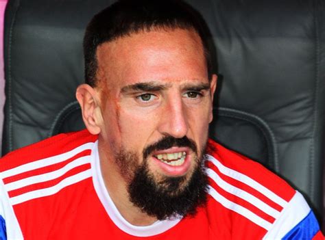 Franck Ribéry Scar - Franck Ribery Photos Photos - France v Uruguay